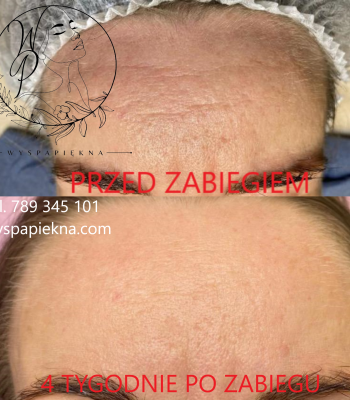 Laser CO2 Wyspa Piękna 4 tyg po zabiegu