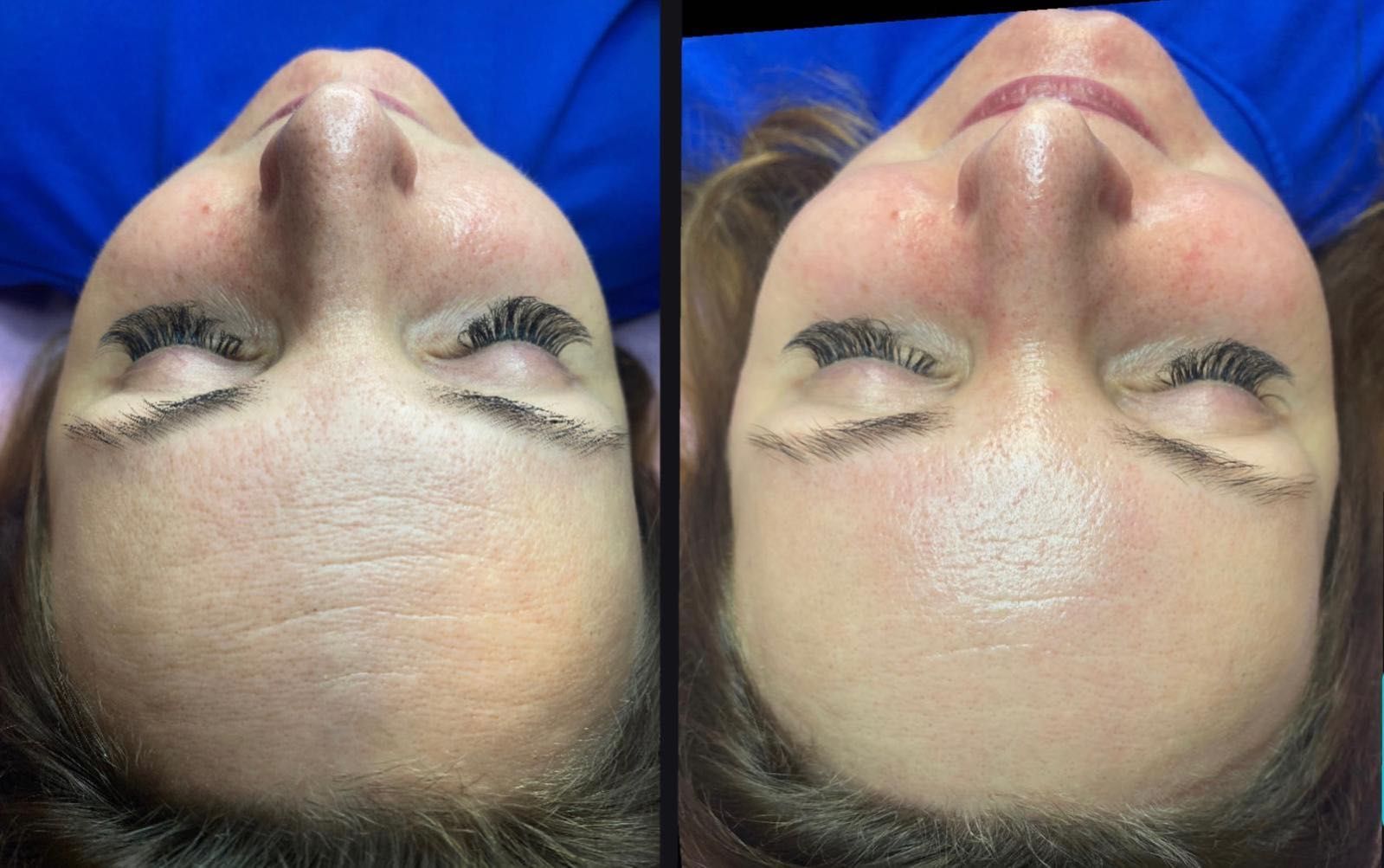 Retinol