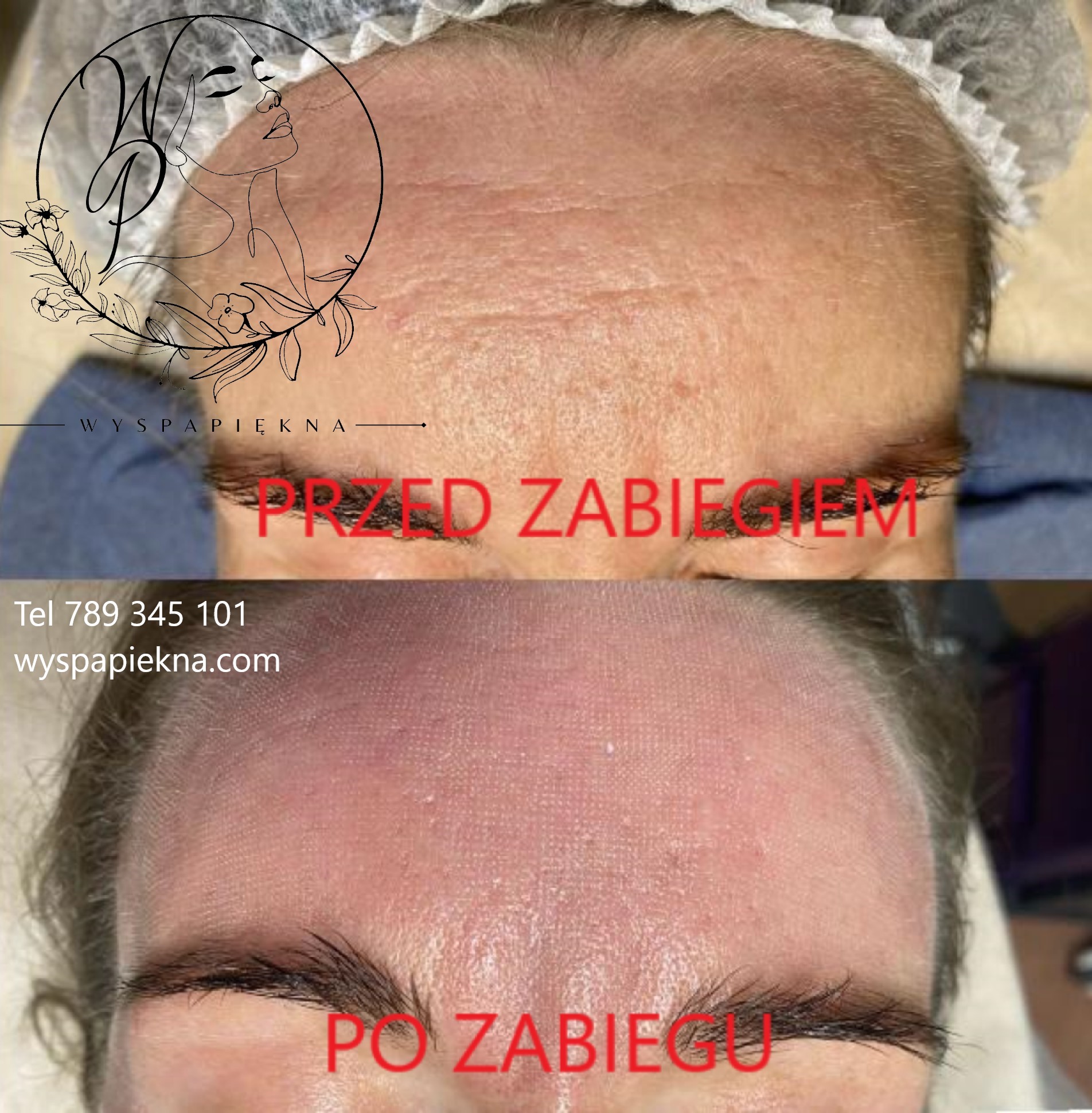 Laser CO2 Wyspa Piękna