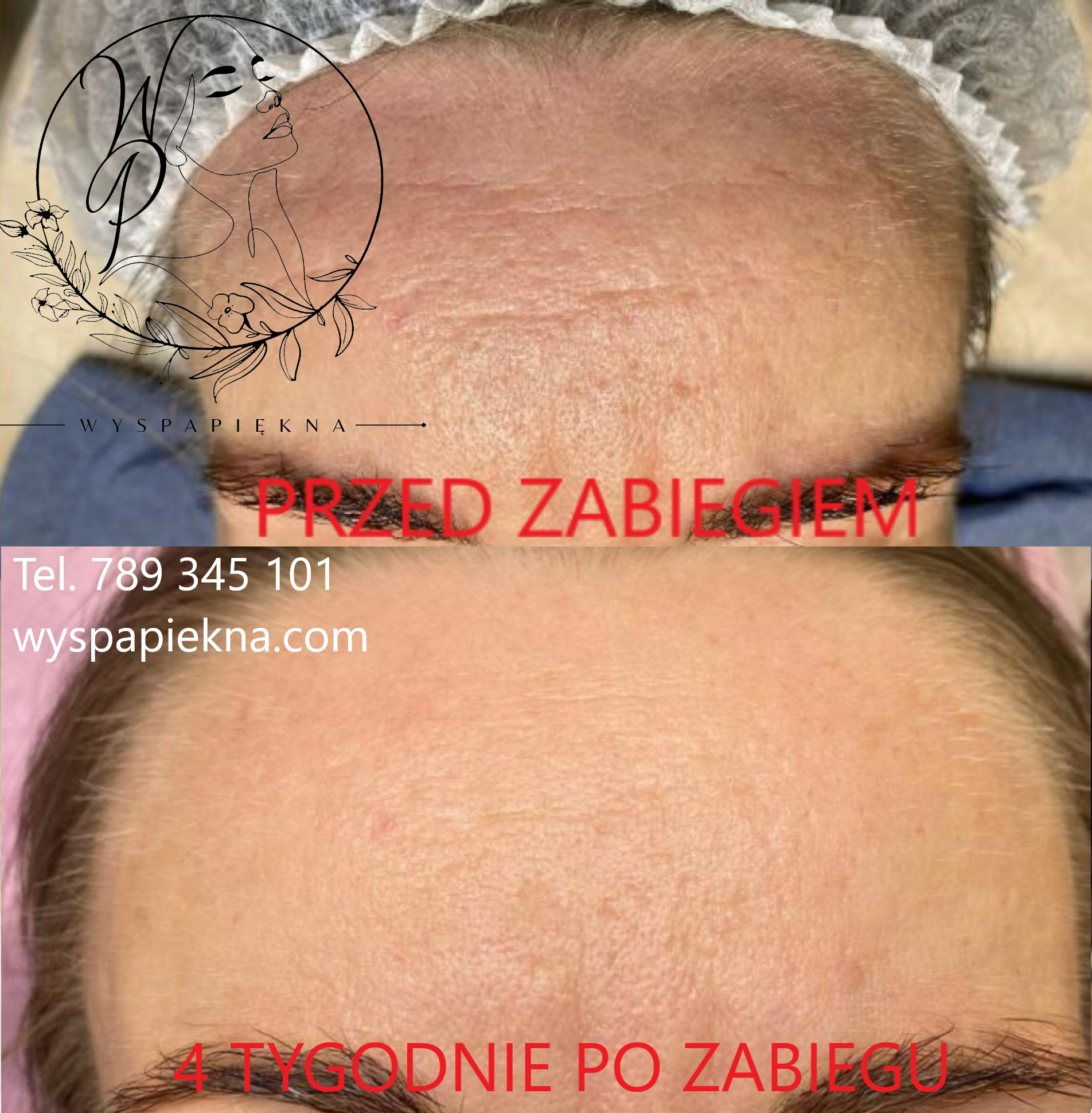 Laser CO2 Wyspa Piękna 4 tyg po zabiegu